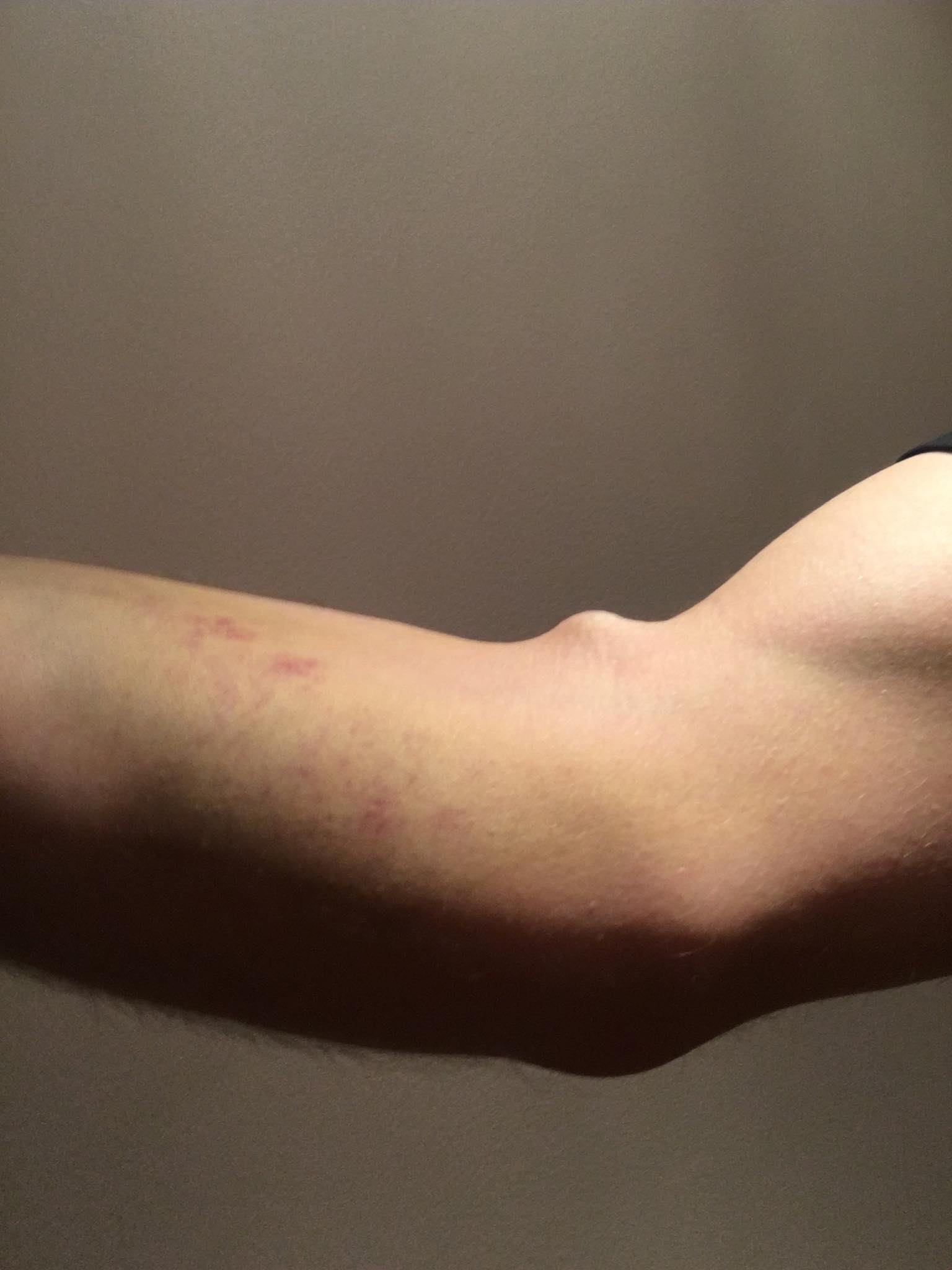 Lump on arm after blood draw : r/AskDocs